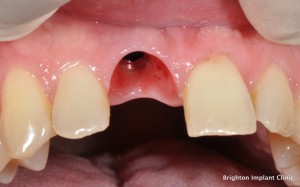 dental implantology showing a dental implant placed