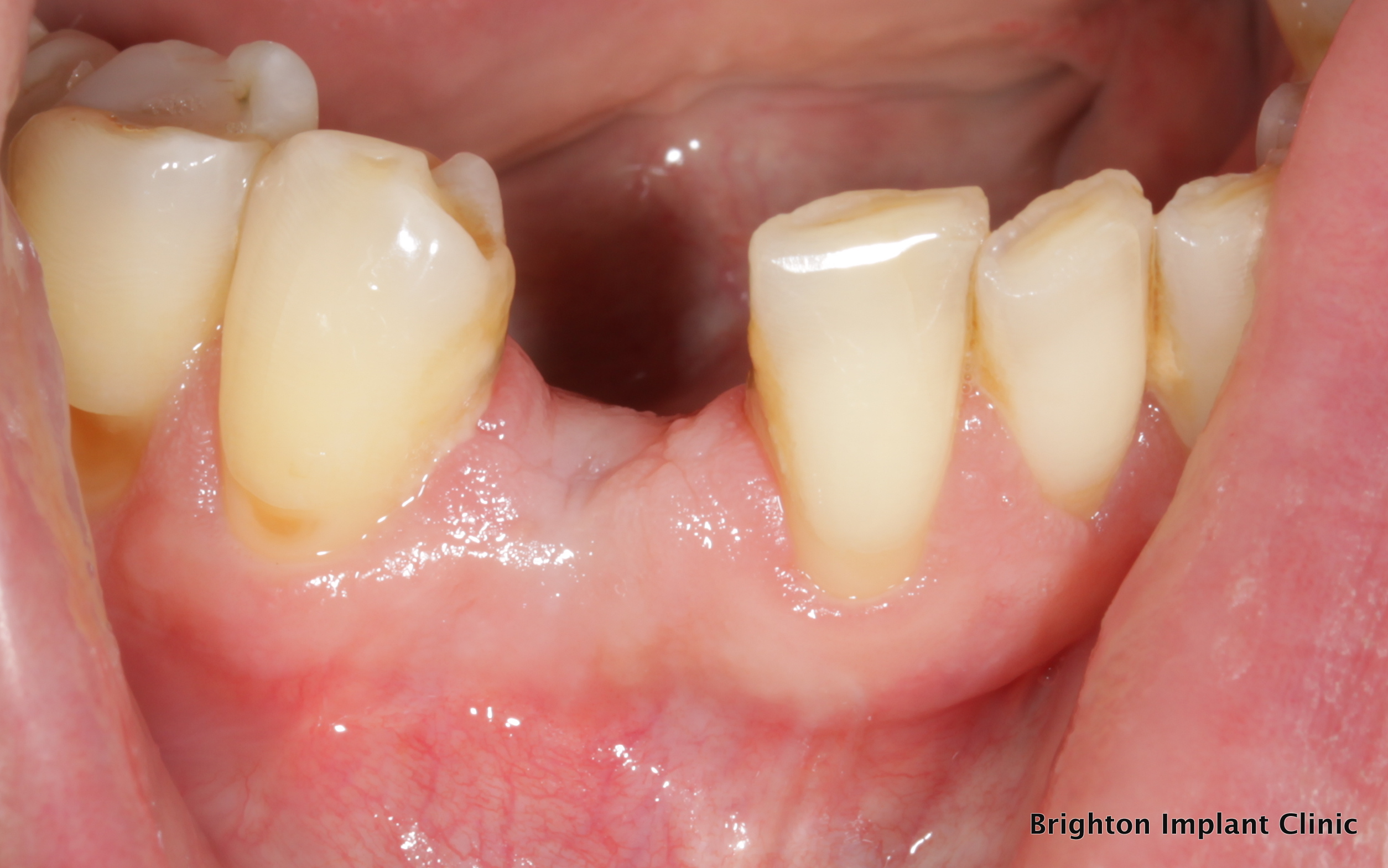 before picture of area prior to dental implant placement