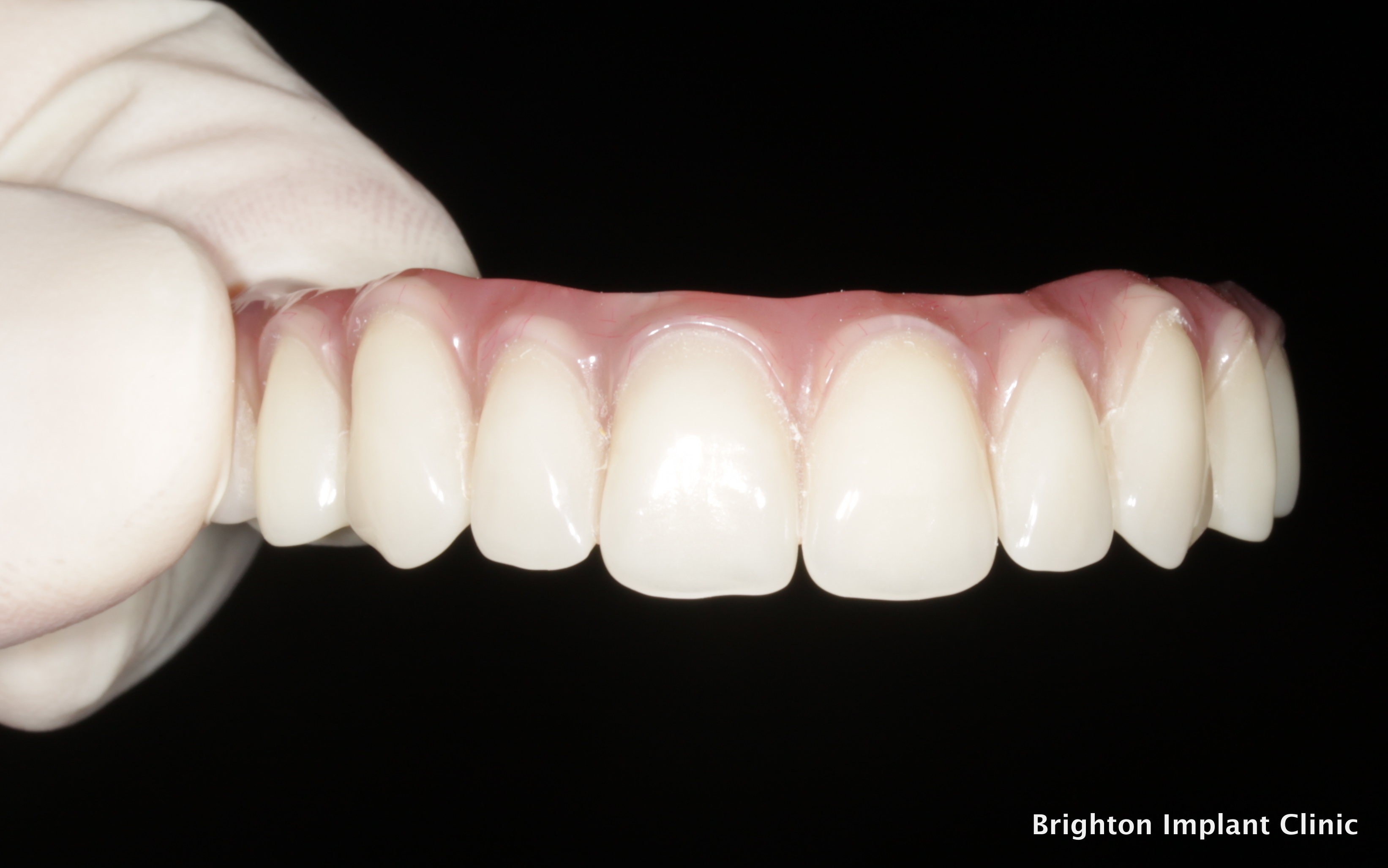 teeth on 4 dental implant bridge