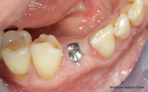 having dental implants Scotland ?