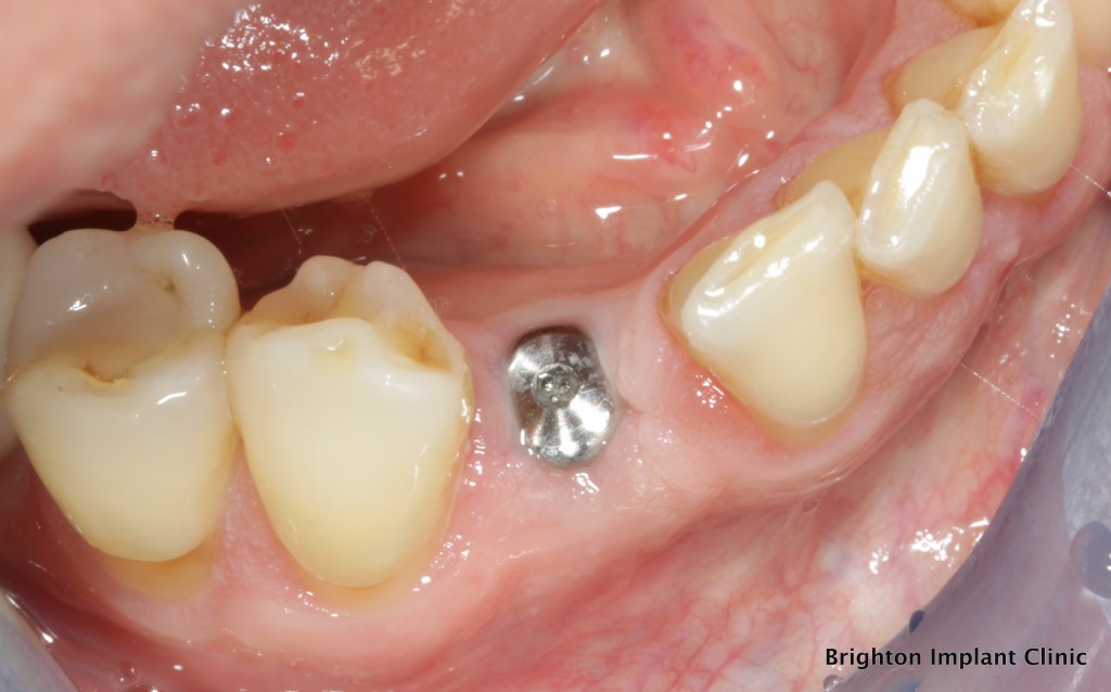 dental implant is left for 3-4 months after surgery to heal