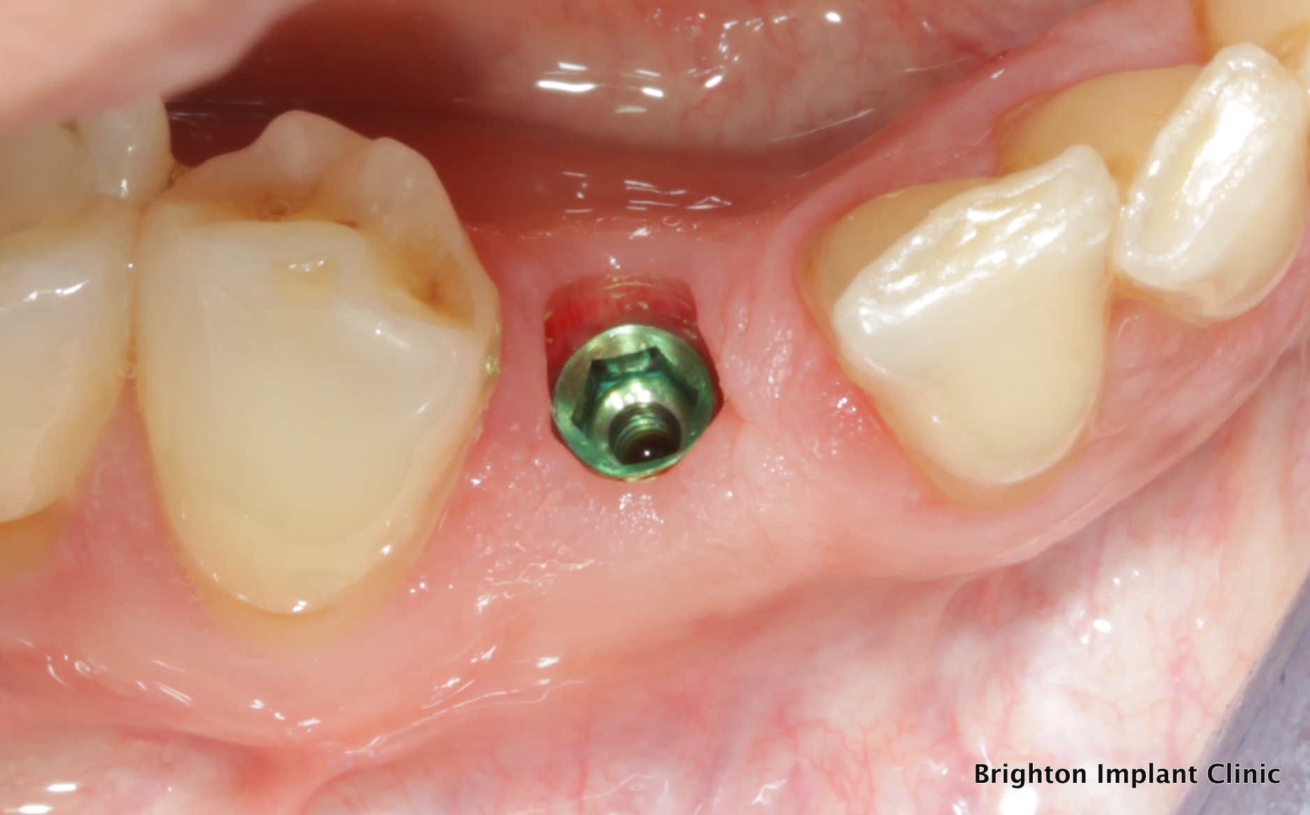 legacy2 dental implant in position