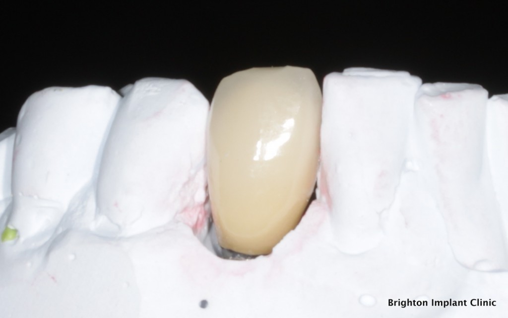 dental implant crown, using VITA porcelain