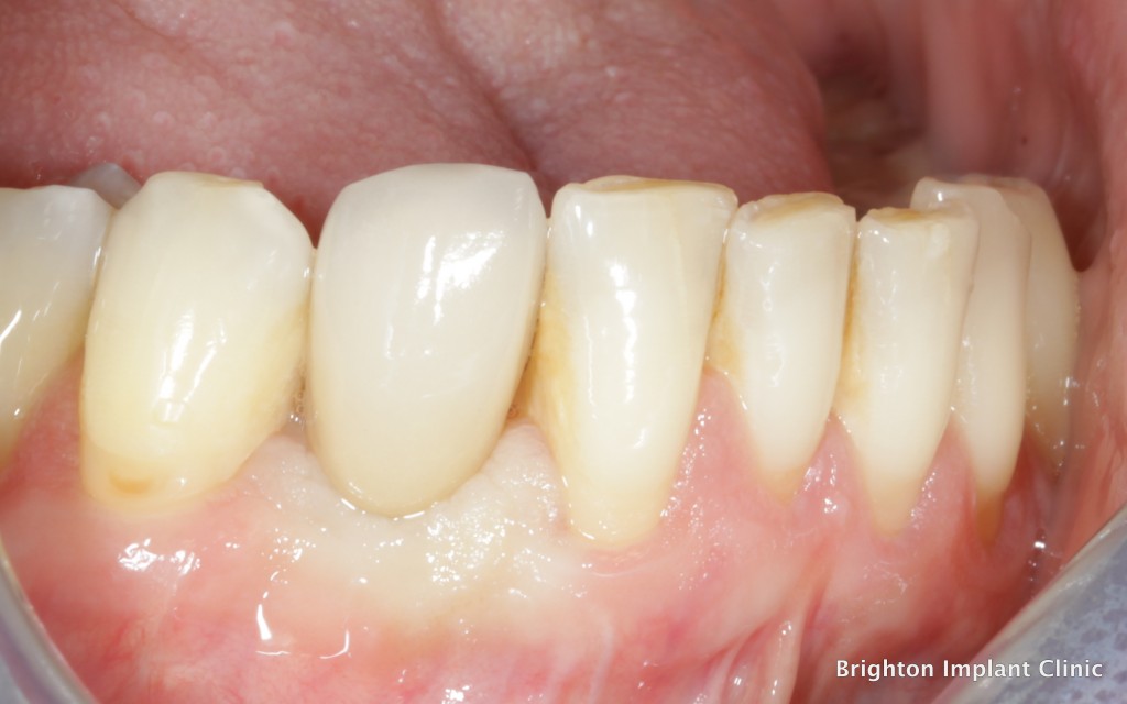 porcelain crown on dental implant