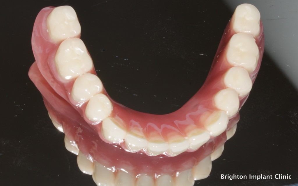 dental implant denture cost for the lower jaw is £2500
