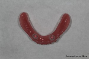 small 'Zest' locator attachments placed in the denture