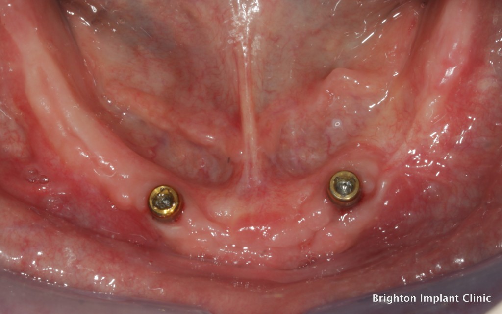 the dental implant denture will click onto the two dental implants as shown in this photo