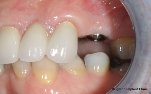 Dental Implant Clinic in hove, hailsham ,brighton