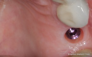 dental implant clinic - brighton implant clinic