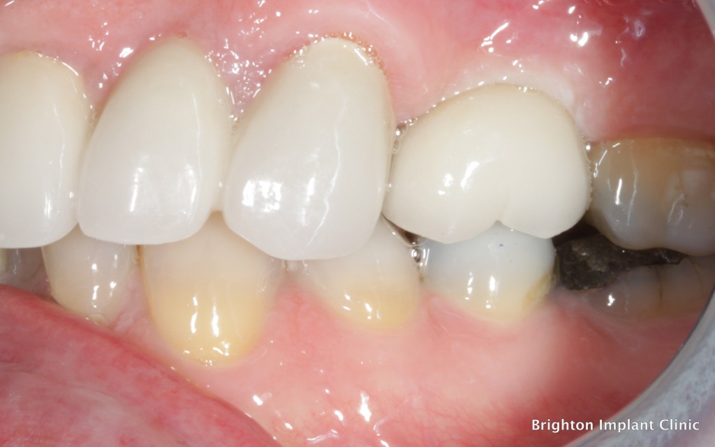 implant dentistry showing restored space