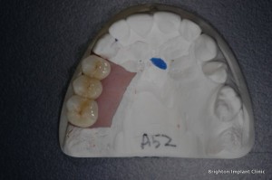 Dental Bridge Treatment