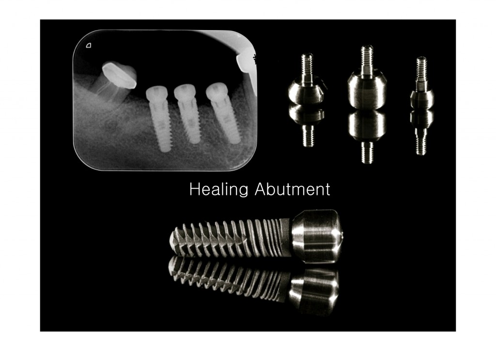 dental implants placed, an example of cheapest dental implants