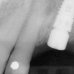 healing abutment placed on dental implant completed
