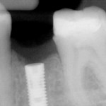 Neodent CM implant at time of surgical placement