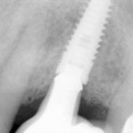 radio graph of bridge on dental implant