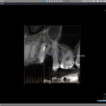 failed root canal treatment ct scan of upper left canine area