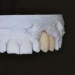 dental implant lab work lab model with porcelain bonded bridge