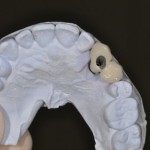 screw retained dental implant bridge porcelain bonded bridge on dental implant