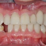 healing abutment on dental implant during the healing phase