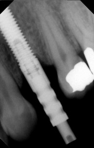 impression coping is taken of the dental implant after placement