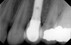dental implant with porcelain fused to metal crown