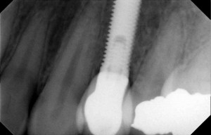 final screw retained implant crown in place