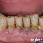 mobile lower teeth due to gum disease