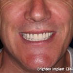 dental implant treatment completed