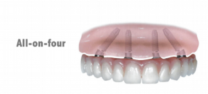 dental bridge supported by dental implants
