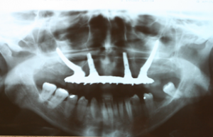dental implant placed, with two standard implants and two zygomatic implants