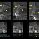 Ct scan views of the areas in question to make sure implants can be placed