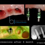 4-6 months after the implants were placed, impressions were taken of the healed implants and surrounding tissues