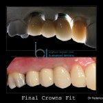 Final result showing a 3 unit bridge on implants plus full ceramic crown on upper right lateral incisor