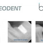 neodent dental implants 4