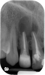 dental infection present on tips of roots