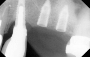 dental implants in place after sinus lift surgery