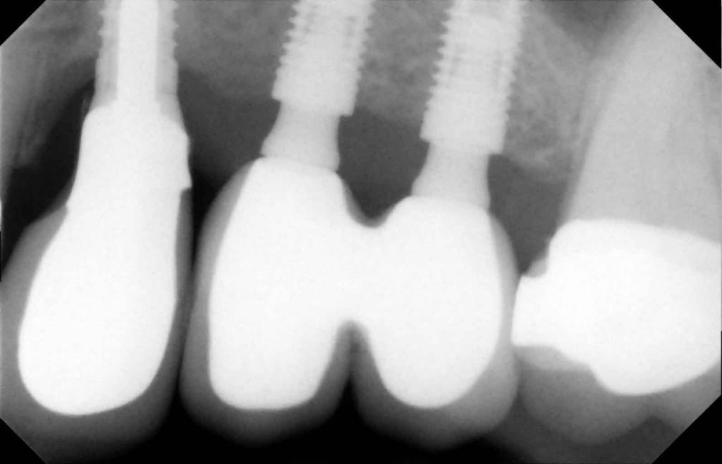 new fixed teeth on dental implants