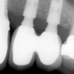 new fixed teeth on dental implants
