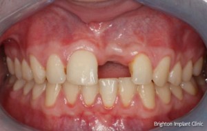 a single dental implant was the most comfortable long term solution for this patient