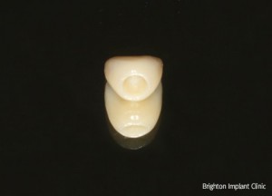 acrylic provisional crown for dental implant