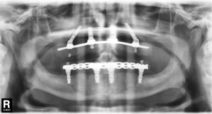 fixed bridges on dental implants in upper and lower arches