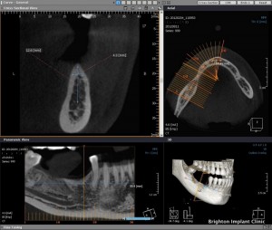 CT scan, lower right premolar extracted before dental implants placed