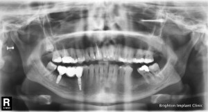 dental implants supporting a 3 unit implant bridge
