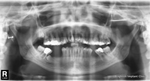 impacted premolar tooth on lower right side