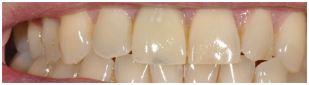 Single Tooth Implant Treatment