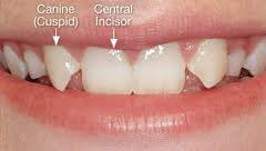 Dental Agenesis And Dental Implants