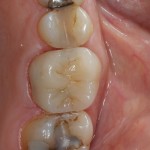 final crown cemented onto molar tooth