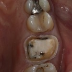 preparation of tooth for crown