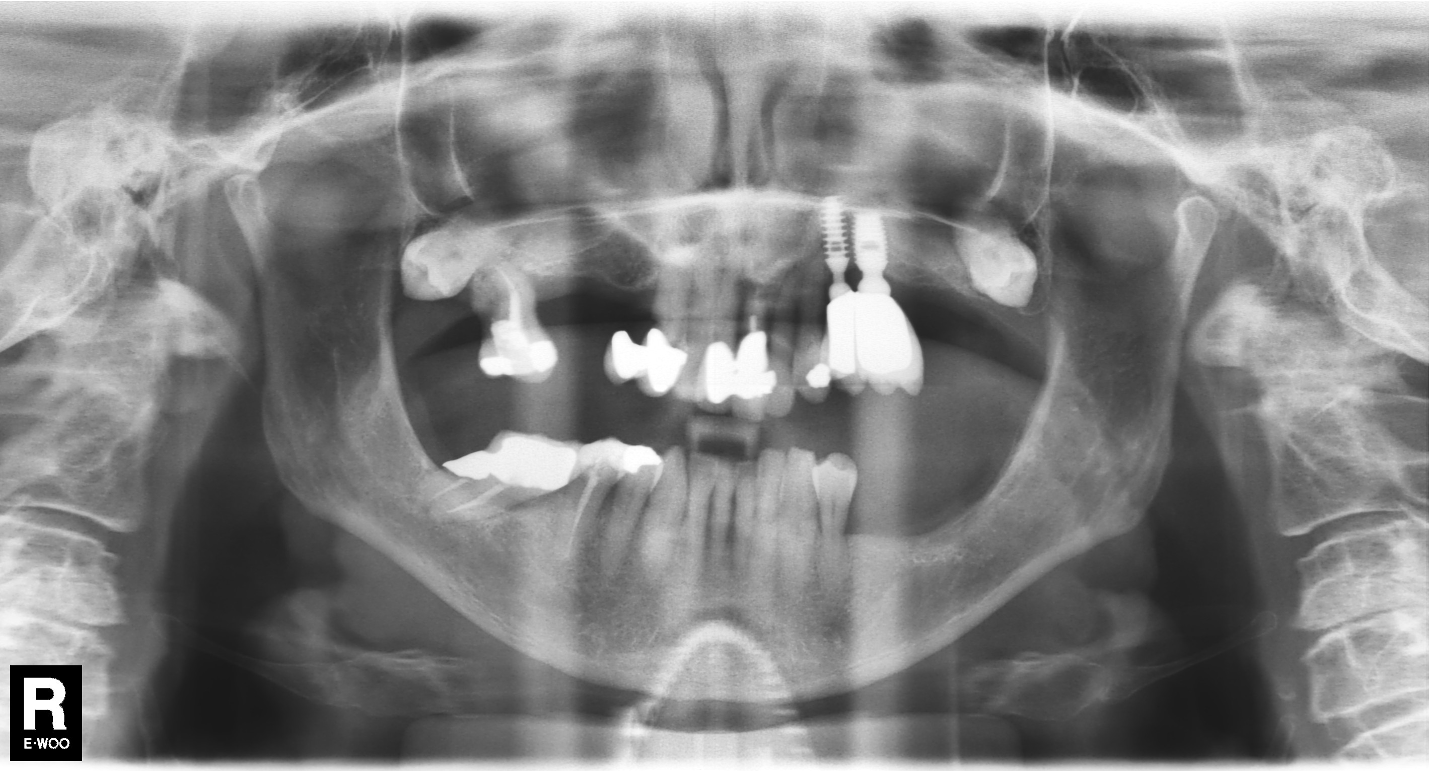 radiograph before dental implant treatment showing existing dental implants and natural teeth