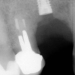 Radiograph showing the completed implant placement,